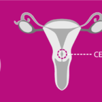 Cervical Cancer