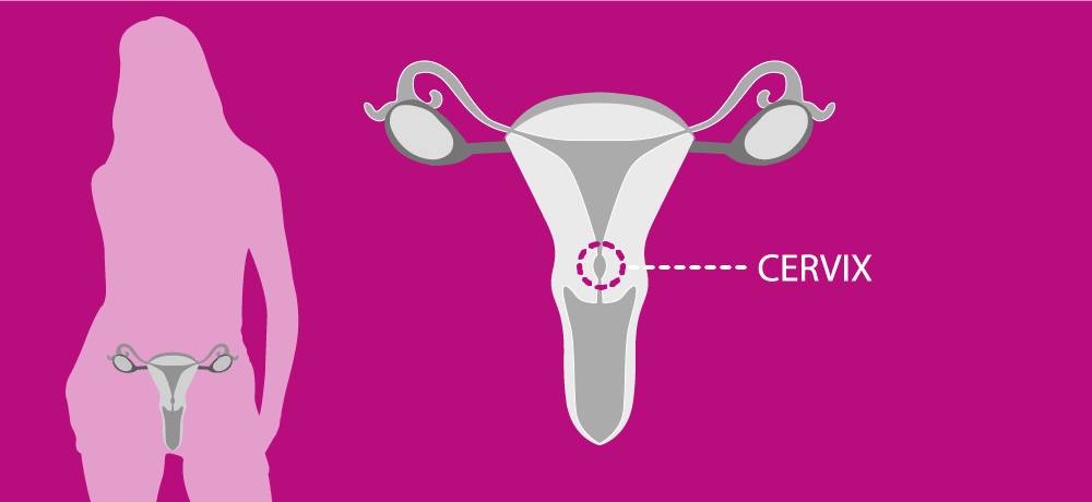 Cervical Cancer Cervical Cancer