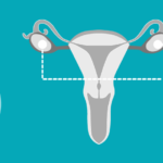 Ovarian Cancer