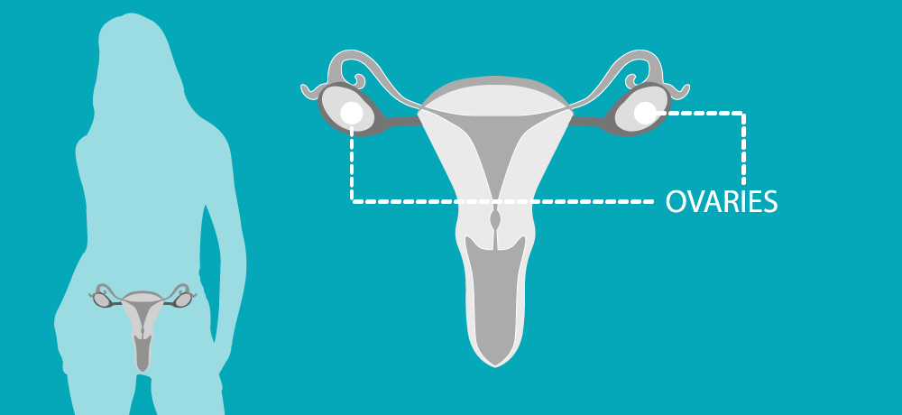 Ovarian Cancer Ovarian Cancer
