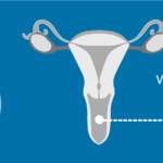 Vaginal Vulval